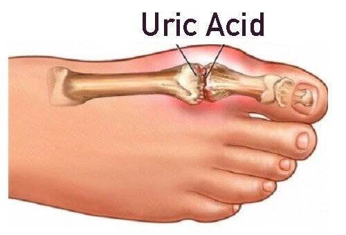 main-qimg-9fb80fd2f25d074e313def19165a79b0-lq uric acid