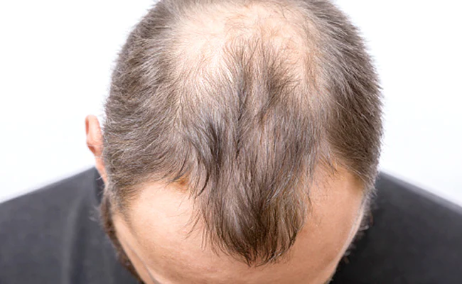 2u89gs6g_hair-fall-in-men_625x300_20_January_23