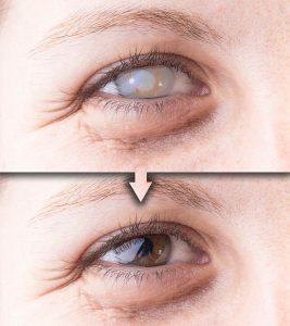 Home Remedies for Cataracts in Hindi 1