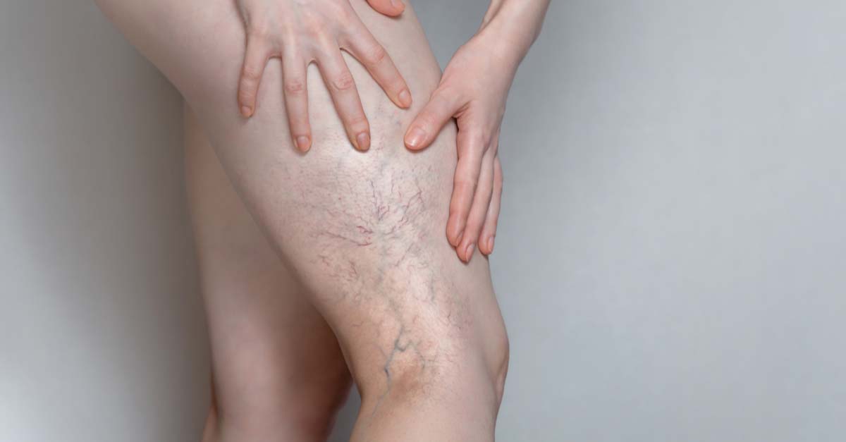 deep-vein-thrombosis-symptoms