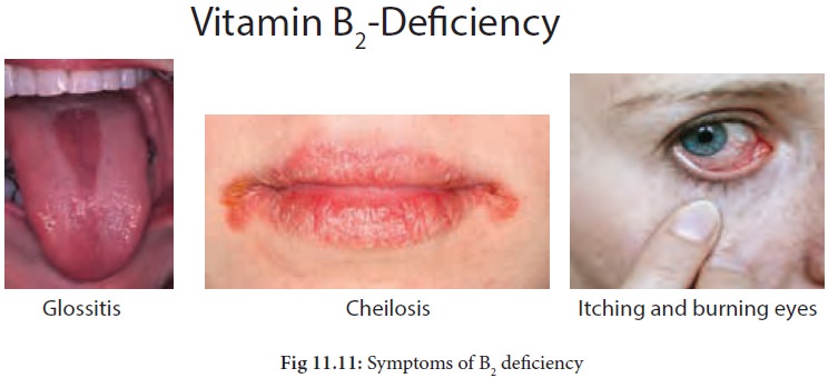 fFX1e3M Riboflavin Deficiency