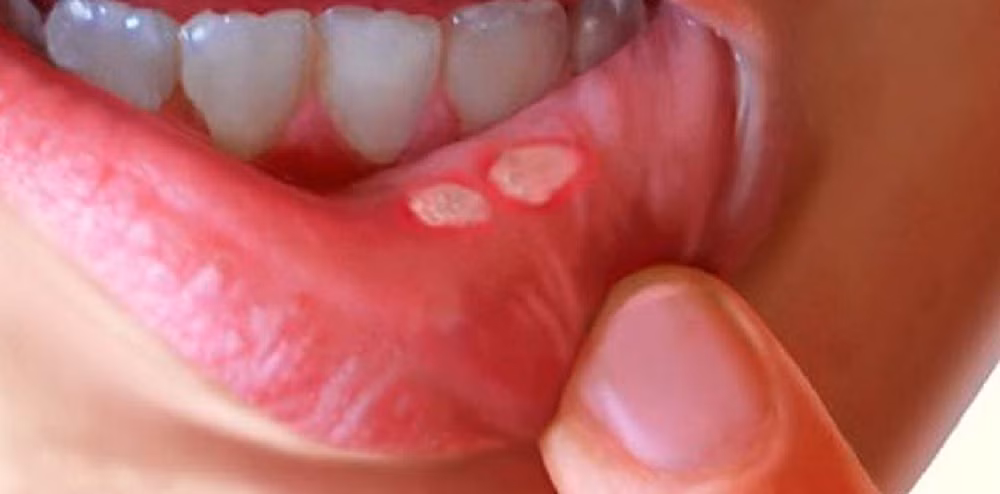 mouth-ulcer_1513158311